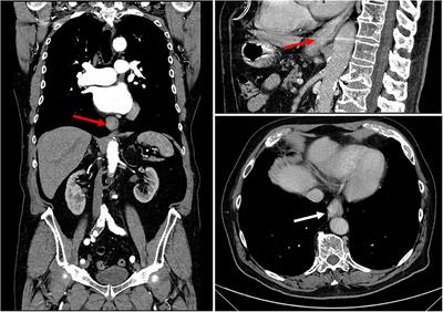 Case Report: Management of Malignancy-Exacerbated Pemphigus Vulgaris During COVID-19 Pandemic